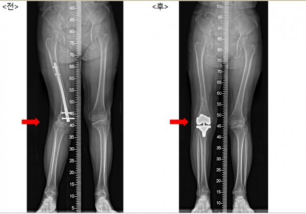 수술 전, 후 모습