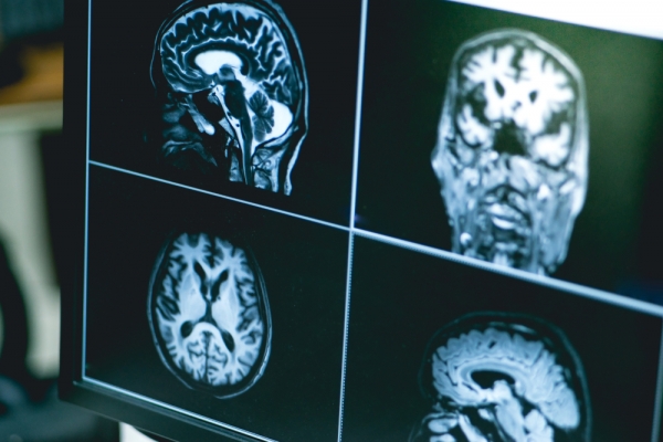 치매환자 뇌 영상 자료