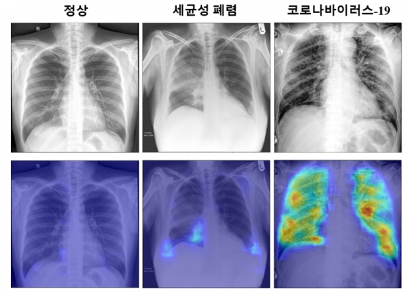 코로나19 진단 알고리즘을 통해 얻은 코로나19 확률 분포 특징 지도의 예