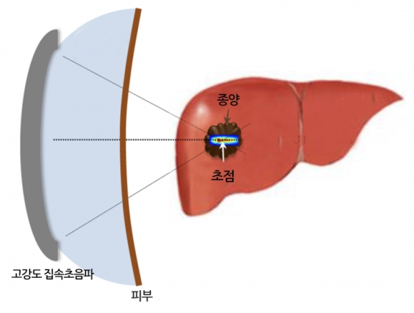 고강도 집속초음파 기반 생체조직 파쇄 기술 개념도.