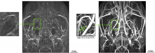 기존 MRI 조영제 뇌혈관지도(왼쪽)와 SAIO 3차원 정밀 뇌혈관지도 비교 모습.