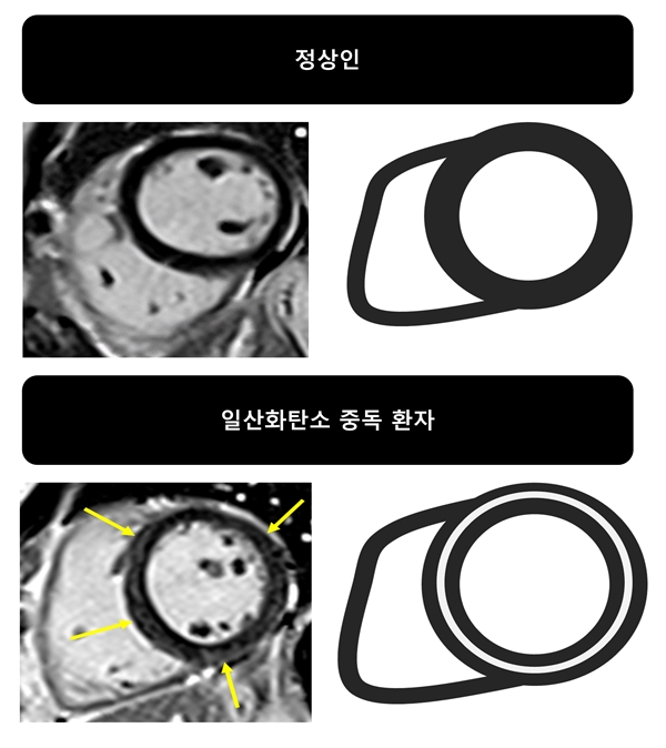 급성일산화탄소중독 환자에서 심장자기공명영상에 의해 발견된 심근손상