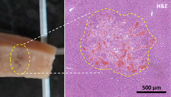 새로 개발한 가변압력 충격파 히스토트립시 기술에 의해 파쇄된 동물의 간 조직