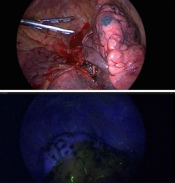 종양 위치 표시 및 형광 염료를 이용한 폐 구역 표시법
