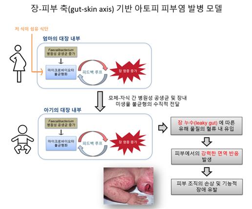 연구팀이 제시한 아토피 피부염 발병 모델